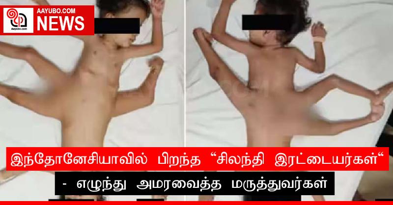 இந்தோனேசியாவில் பிறந்த 'சிலந்தி இரட்டையர்கள்' - எழுந்து அமரவைத்த மருத்துவர்கள்