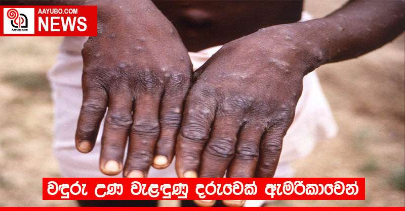 වඳුරු උණ වැළඳුණු දරුවෙක් ඇමරිකාවෙන්