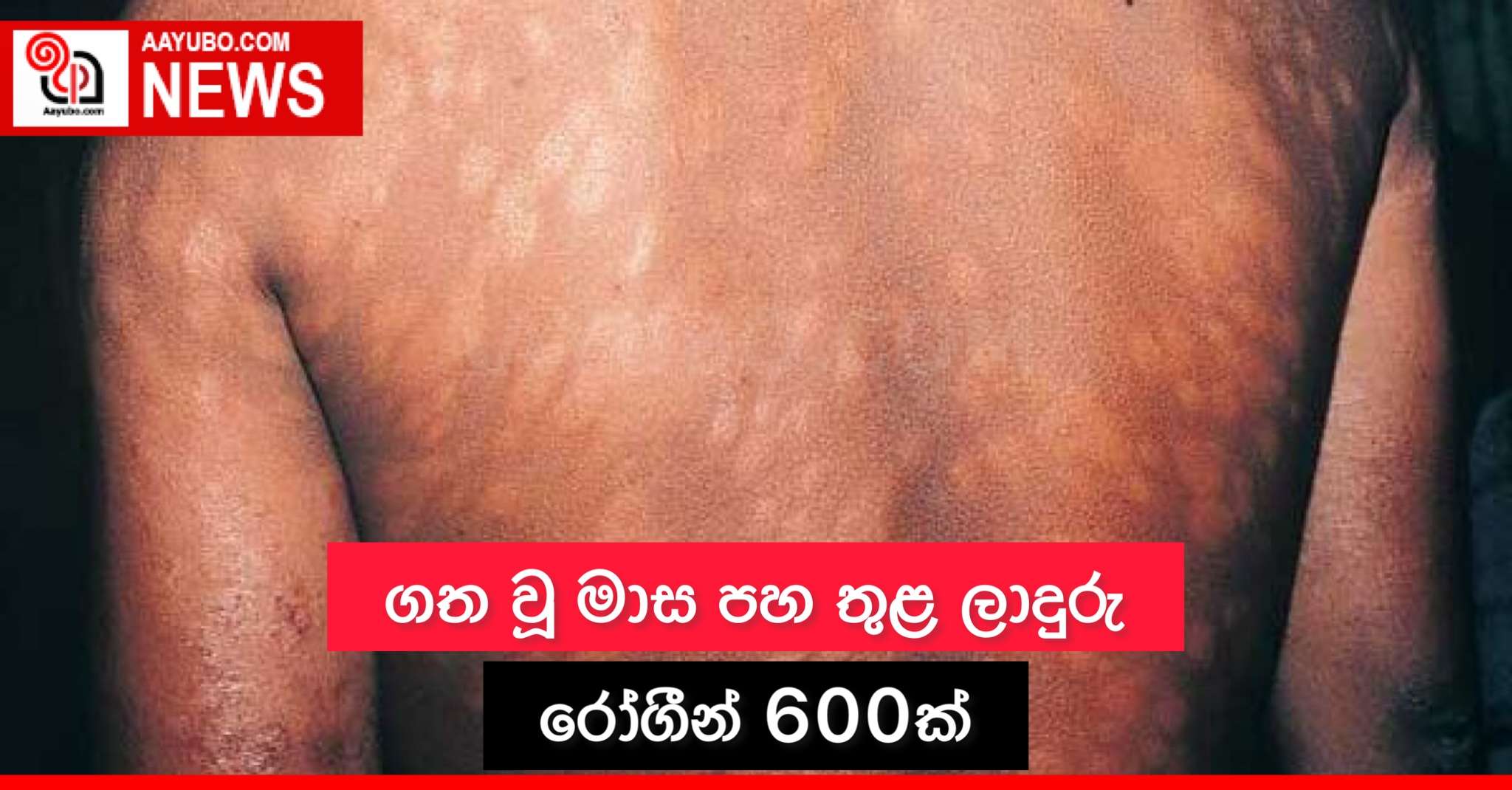 ගතවූ මාස පහ තුළ ලාදුරු රෝගීන් 600ක්