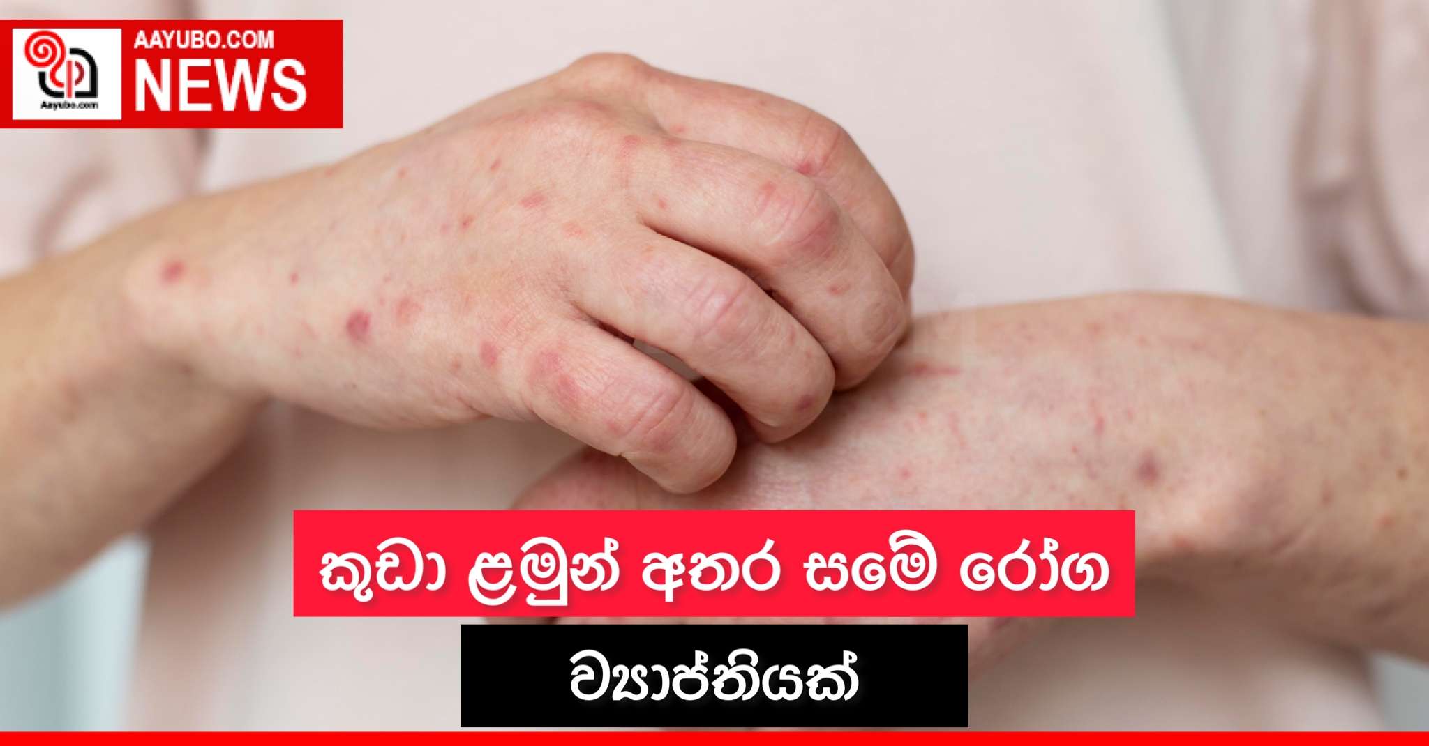 කුඩා ළමුන් අතර සමේ රෝග ව්‍යාප්තියක්