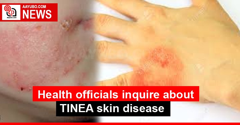 Health officials inquire about TINEA skin disease