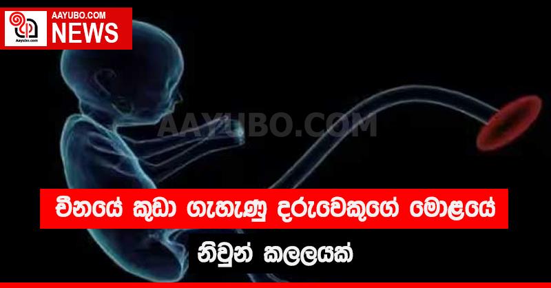 චීනයේ කුඩා ගැහැණු දරුවෙකුගේ මොළයේ නිවුන් කලලයක්