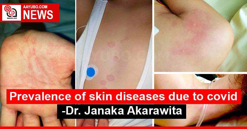 Prevalence of skin diseases due to covid - Dr. Janaka Akarawita