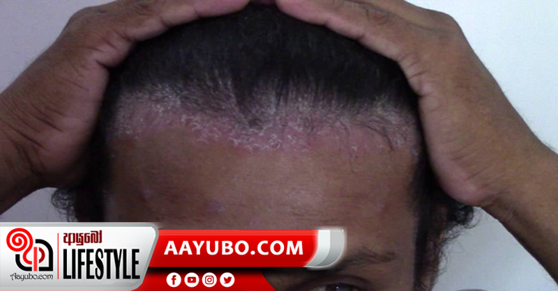 පොතු කබර රෝගය ගැන දැනුවත් වෙමු