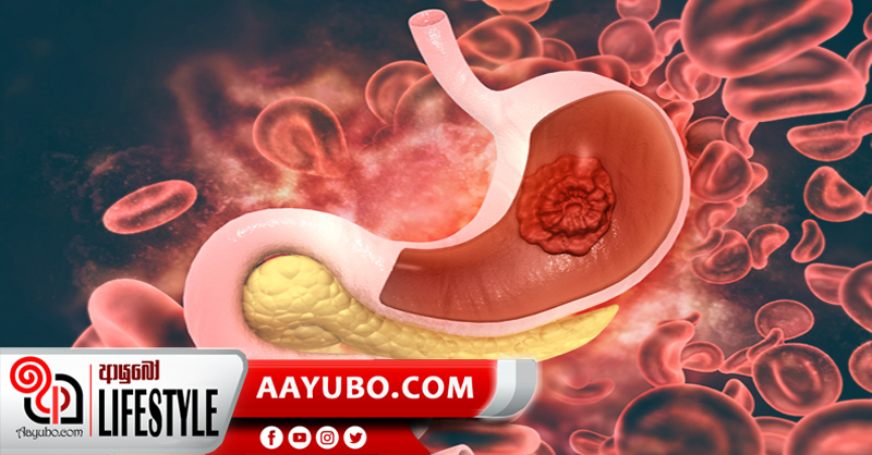 බඩවැලේ පිළිකා නසන ප්‍රතිකාර
