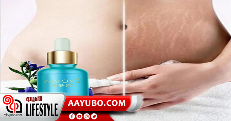 ස්ට්‍රෙච් මාර්ක් නැති කරන තෙල් සත්කාර