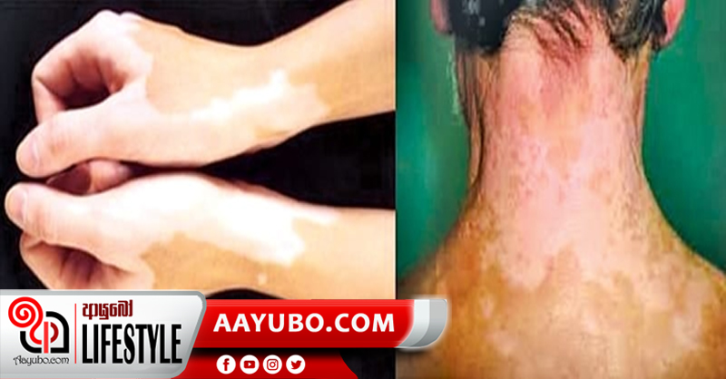 සුදු කබර රෝගය සුව කර ගැනීමට පුලුවන්ද ?