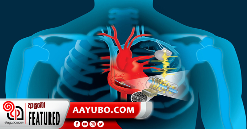 හදවත ක්‍රියාවිරහිත වීම වළකන පේස් මේකර්